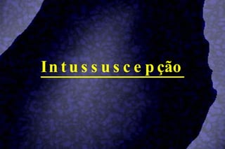 Intussuscepção 
