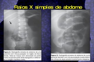 Raios X simples de abdome 