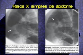 Raios X simples de abdome 
