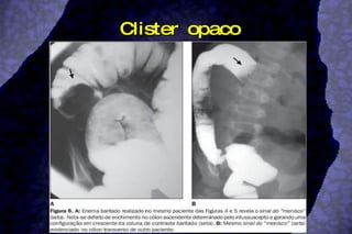 Clister opaco 