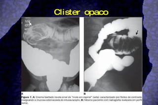 Clister opaco 