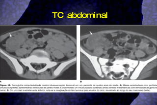 TC abdominal 