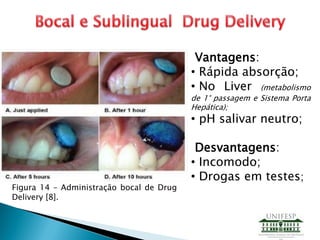 Figura 14 – Administração bocal de Drug
Delivery [8].
Vantagens:
• Rápida absorção;
• No Liver (metabolismo
de 1° passagem e Sistema Porta
Hepática);
• pH salivar neutro;
Desvantagens:
• Incomodo;
• Drogas em testes;
 