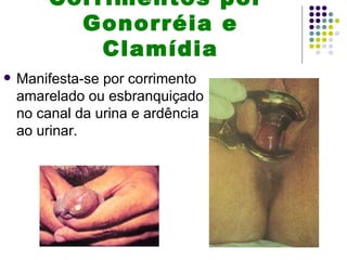 Corrimentos por
          Gonorréia e
            Clamídia
   Manifesta-se por corrimento
    amarelado ou esbranquiçado
    no canal da urina e ardência
    ao urinar.
 