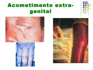 Acometimento extra-
     genital
 