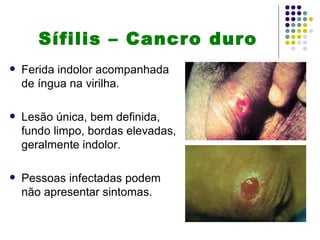 Sífilis – Cancro duro
   Ferida indolor acompanhada
    de íngua na virilha.

   Lesão única, bem definida,
    fundo limpo, bordas elevadas,
    geralmente indolor.

   Pessoas infectadas podem
    não apresentar sintomas.
 