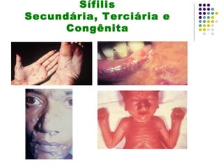 Sífilis
Secundária, Terciária e
      Congênita
 