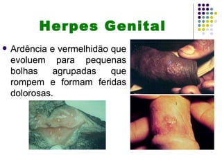 Herpes Genital
   Ardência e vermelhidão que
    evoluem para pequenas
    bolhas    agrupadas    que
    rompem e formam feridas
    dolorosas.
 