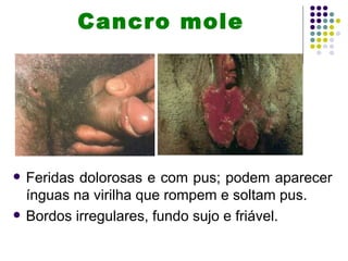Cancro mole




   Feridas dolorosas e com pus; podem aparecer
    ínguas na virilha que rompem e soltam pus.
   Bordos irregulares, fundo sujo e friável.
 