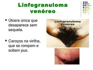Linfogranuloma
venéreo
 Úlcera única que
desaparece sem
sequela.
 Caroços na virilha,
que se rompem e
soltam pus.
 