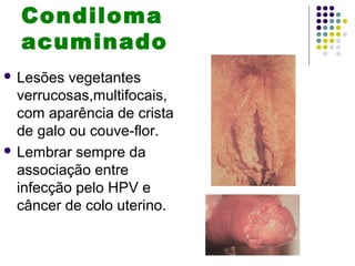 Condiloma
acuminado
 Lesões vegetantes
verrucosas,multifocais,
com aparência de crista
de galo ou couve-flor.
 Lembrar sempre da
associação entre
infecção pelo HPV e
câncer de colo uterino.
 