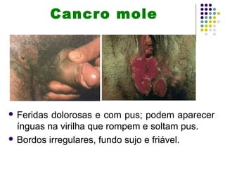 Cancro mole
 Feridas dolorosas e com pus; podem aparecer
ínguas na virilha que rompem e soltam pus.
 Bordos irregulares, fundo sujo e friável.
 