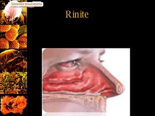 Rinite Conhecida por “Febre dos fenos”, os sintomas são o corrimento nasal acompanhado de lacrimejo, espirros frequentes e sensação de pressão na cabeça. 
