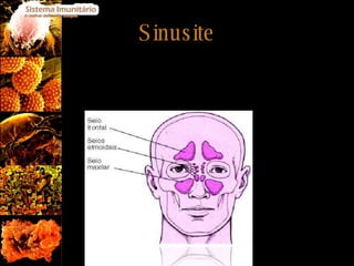 Sinusite A sinusite é causada por alergias repetidas do nariz, nas quais, os ossos à volta do nariz inflamam e ficam obstruídos impedindo o ar de circular no seu interior. Esta alergia causa dores e corrimento de pus nas zonas afectadas. 