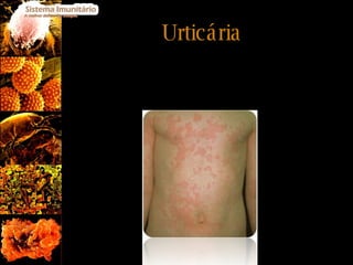 Urticária Manifesta-se por zonas na pele mais elevadas e avermelhadas com presença de comichão. Esta alergia surge com frequência e aparecem na sequência de factores irritantes como alimentos, medicamentos, picadas de insectos ou reacções emocionais. 