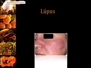 Lúpus O paciente desenvolve anticorpos que reagem contra as suas células normais, podendo afectar a pele, as articulações,...