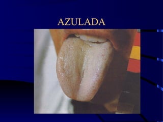 AZULADA
 