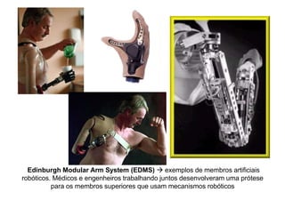 Edinburgh Modular Arm System (EDMS)  exemplos de membros artificiais
robóticos. Médicos e engenheiros trabalhando juntos desenvolveram uma prótese
para os membros superiores que usam mecanismos robóticos
 