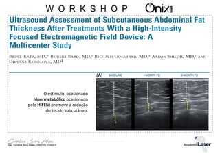 O estimulo ocasionado
hipermetabólico ocasionado
pelo HIFEM promove a redução
do tecido subcutâneo.
 