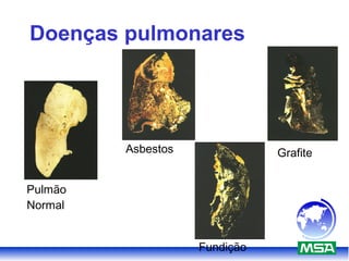 Doenças pulmonares
Pulmão
Normal
Asbestos Grafite
Fundição
 