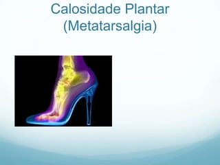 Calosidade Plantar(Metatarsalgia)