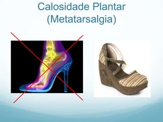 Calosidade Plantar(Metatarsalgia)