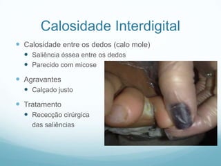 Calosidade InterdigitalCalosidade entre os dedos (calo mole)Saliência óssea entre os dedosParecido com micoseAgravantesCalçado justoTratamentoRececção cirúrgica	das saliências