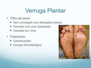 Verruga Plantar“Olho de peixe”Sem correlação com alterações ósseasParecido com uma calosidadeCausado por vírusTratamentoCauterizaçõesCirurgia Dermatológica