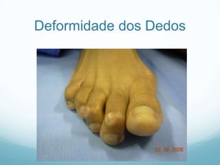 Deformidade dos Dedos