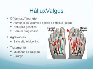HálluxValgusO “famoso” joaneteAumento de volume e desvio do Hállux (dedão)Natureza genéticaCaráter progressivoAgravantesSalto alto e bico finoTratamentoMudança do calçadoCirurgia