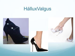 HálluxValgus
