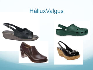 HálluxValgus