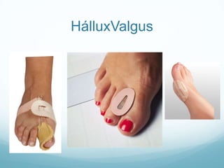 HálluxValgus