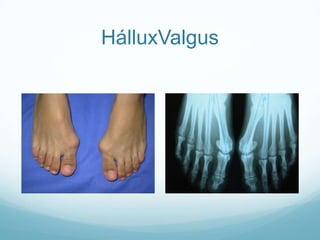 HálluxValgus