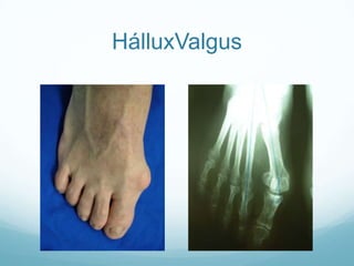HálluxValgus