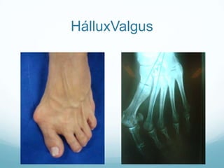 HálluxValgus