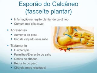 Esporão do Calcâneo (fasceíte plantar)Inflamação na região plantar do calcâneoComum nos pés cavosAgravantesAumento do pesoUso de calçado sem saltoTratamentoFisioterapiaPalmilhas/Elevação do saltoOndas de choqueRedução do pesoCirurgia (mau resultado)