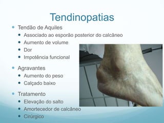 TendinopatiasTendão de AquilesAssociado ao esporão posterior do calcâneoAumento de volumeDorImpotência funcionalAgravantesAumento do pesoCalçado baixoTratamentoElevação do saltoAmortecedor de calcâneo Cirúrgico