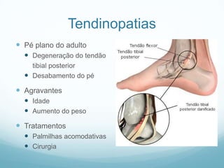 TendinopatiasPé plano do adultoDegeneração do tendão	tibial posteriorDesabamento do péAgravantesIdadeAumento do pesoTratamentosPalmilhas acomodativasCirurgia