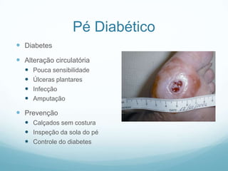 Pé DiabéticoDiabetesAlteração circulatóriaPouca sensibilidadeÚlceras plantaresInfecçãoAmputaçãoPrevençãoCalçados sem costuraInspeção da sola do péControle do diabetes