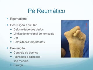 Pé ReumáticoReumatismoDestruição articularDeformidade dos dedosLimitação funcional do tornozeloDorCalosidades importantesPrevençãoControle da doençaPalmilhas e calçados	sob medida.Cirurgia