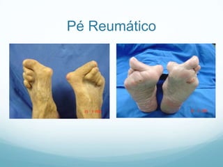 Pé Reumático