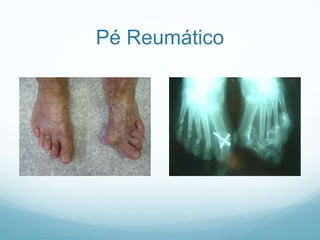 Pé Reumático