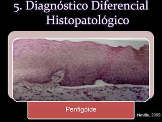 5. Diagnóstico Diferencial  HistopatológicoNeville, 2009