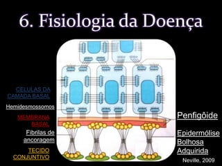 CELULAS DA CAMADA BASALHemidesmossomosPenfigôideMEMBRANA BASALEpidermólise Bolhosa AdquiridaFibrilas de ancoragemTECIDO CONJUNTIVO6. Fisiologia da DoençaNeville, 2009
