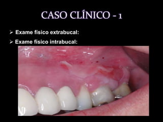 Queixa:Avaliar lesões gengivais dolorosas, ulceradas e descamativas.CASO CLÍNICO - 1