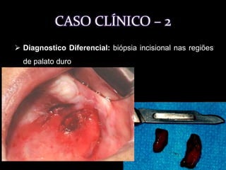 Biópsia incisional - análise anatomopatológica. 