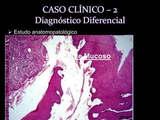 O resultado - lâmina corada em hematoxilina (he) foi de BOLHA SUBEPITELIAL sugestiva de PENFIGÓIDE BENIGNO DE MUCOSA.  CASO CLÍNICO – 1