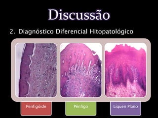 Bochecho de 5mL de Elixir de Dexametasona (0,5mg) 04 vezes ao dia