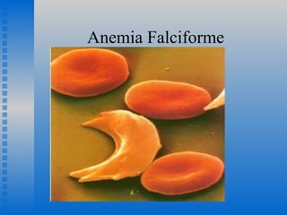 Anemia Falciforme 